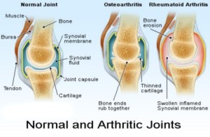 arthritic_joints_6547654